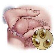 scurgeri de chlamydia