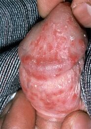 scurgeri din penis din cauza afte